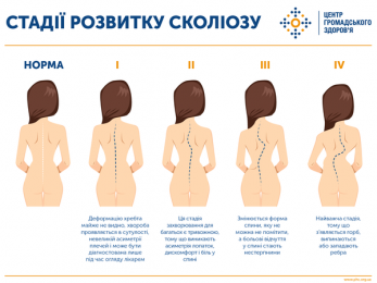 30 червня – Міжнародний день боротьби зі сколіозом