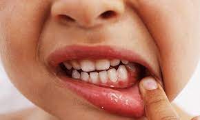 КРОВОТОЧАТЬ ЯСНА ? ЧИ ЗНАЄТЕ ВИ НАСКІЛЬКИ ЦЕ НЕБЕЗПЕЧНО ?