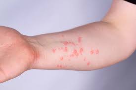 ДО РЕФЕРЕНС-ЛАБОРАТОРІЇ ЦГЗ НАДІЙШОВ ЗРАЗОК ДРУГОГО ХВОРОГО З ПІДОЗРОЮ НА ВІСПУ МАВП