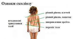 Підлітковий сколіоз