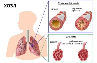 Міфи та правда про інсульт Міфи та правда про інсульт