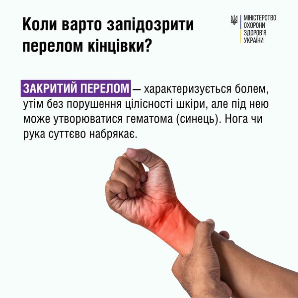 Розповідаємо базову інформацію про те, що робити у разі перелому, та які вони бувають