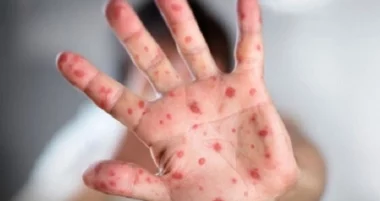 Стандартизований план готовності та реагування на спалах кору у разі його виникнення