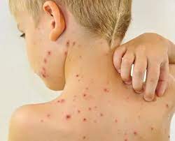 В УКРАНІ ЗАРЕЄСТРОВАНІ ДВА ВИПАДКИ КОРУ