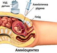 SPINA BIFIDA (Спіна біфіда)  Синоніми захворювання: спіна біфіда, мозкова грижа