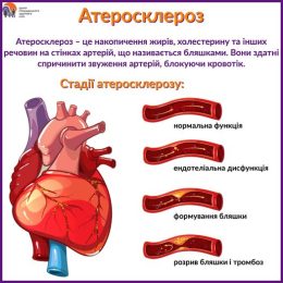 Атеросклероз: що це таке та як його уникнути