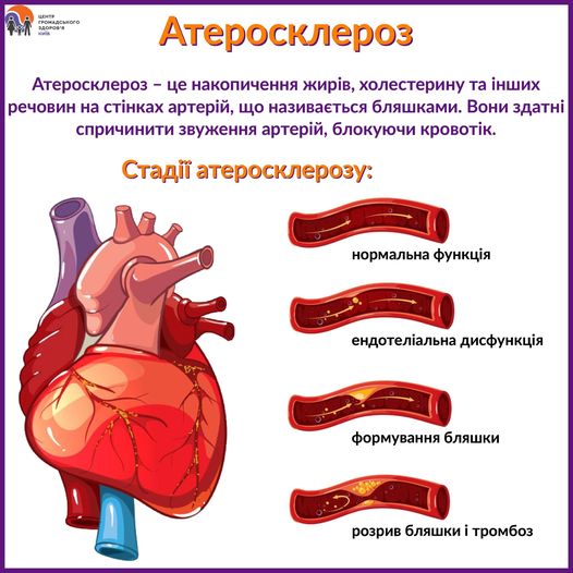 Атеросклероз: що це таке та як його уникнути