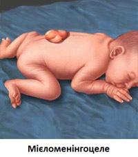 SPINA BIFIDA (Спіна біфіда)  Синоніми захворювання: спіна біфіда, мозкова грижа