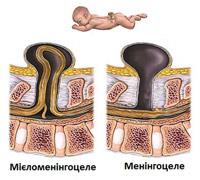 SPINA BIFIDA (Спіна біфіда)  Синоніми захворювання: спіна біфіда, мозкова грижа