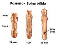 SPINA BIFIDA (Спіна біфіда)  Синоніми захворювання: спіна біфіда, мозкова грижа