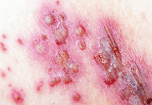 Вітряна віспа (“вітрянка”) – це надзвичайно заразне захворювання