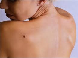 ТРАВЕНЬ — МІСЯЦЬ ОБІЗНАНОСТІ ПРО МЕЛАНОМУ