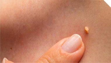 Вірус папіломи людини (ВПЛ, HPV)