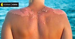 Сонячні опіки