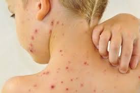 Попередній спалах кору лютував в Україні у 2017–2019 роках