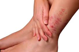 Бешихове запалення, або бешиха (Рожа)