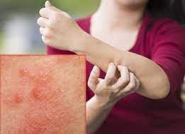 Як вберегтися від корости ?