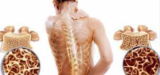 Остеопороз