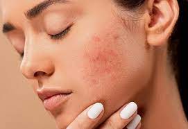 Що таке церкаріоз?