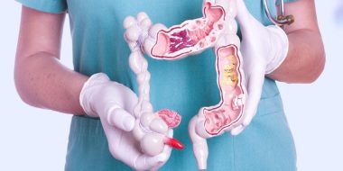 РАК ПРЯМОЇ КИШКИ