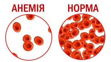 Анемія