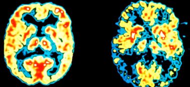 Хвороба Альцгеймера