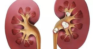 Як уникнути каменів у нирках