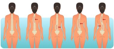 Сколіоз – це не просто "крива спина"