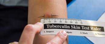 Що таке проба Манту?