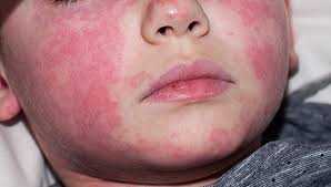 Скарлатина