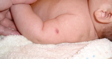 Ваша дитина має щеплення БЦЖ?