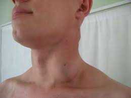 Які симптоми ВІЛ?