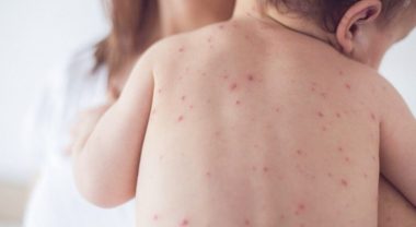 Вітряна віспа (вітрянка)