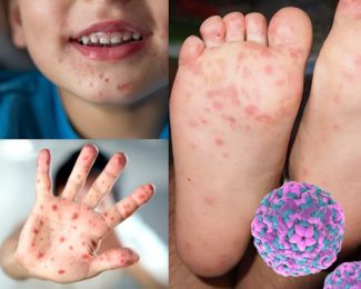 Вірус Коксакі