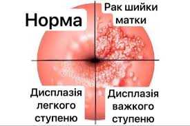 Рак шийки матки
