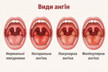 Ангіна — «звичайний біль у горлі» чи серйозна небезпека?