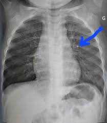 Позалегеневий туберкульоз